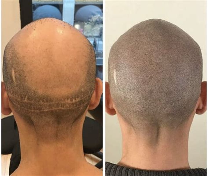 Chris Eubank Jr. Net Worth And Hair Tattoo, Transplant