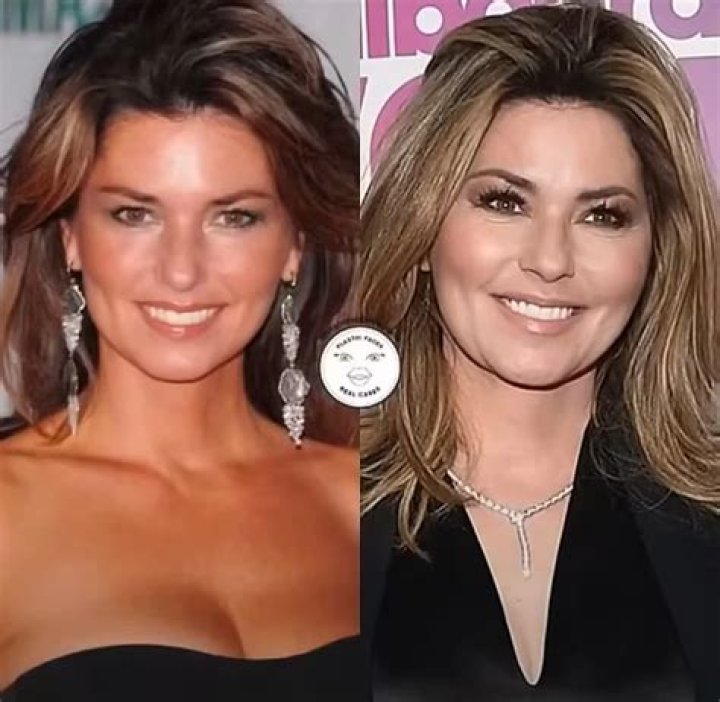 Has Shania Twain Had Plastic Surgery? Singer Multiple Throat Surgeries And Face Details
