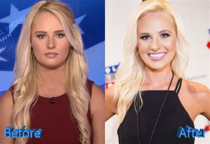 
Has Tomi Lahren Had Plastic Surgery? Before And After Photos On IG 