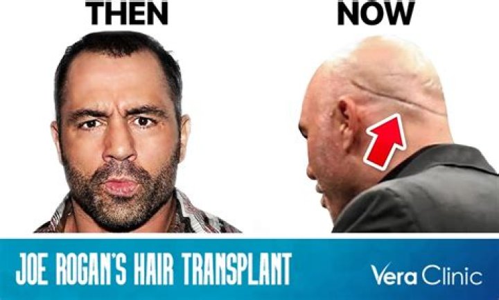 Kenny Smith Hair Loss and Surgery Rumors, Did The Commentator Undergo Transplant?