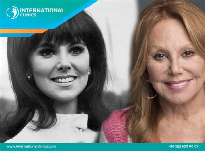 
Marlo Thomas Botox Before And After Photos -Did She Have A Facelift? 