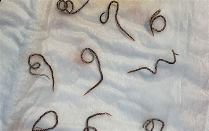 
Sam Ballard Trending On Reddit Again, Death By Eating Slug As He Got Infected With Rat Lungworm 