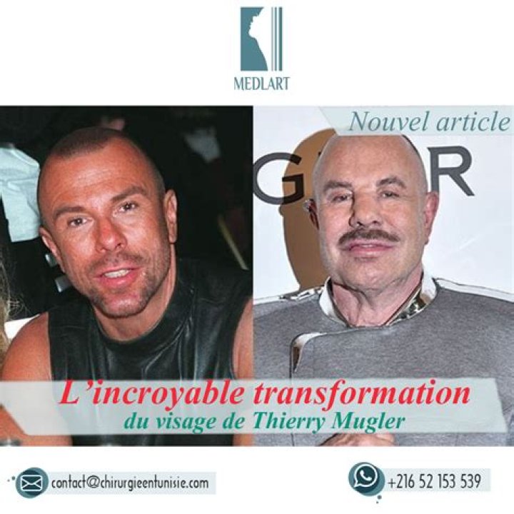 Thierry Mugler Before Surgery Pictures: Face and Nose Plastic Surgery Update