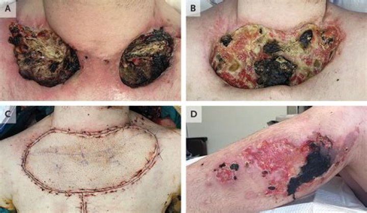 
What is Tranq? Zombie drugs wounds pictures sparks panic and concern online 